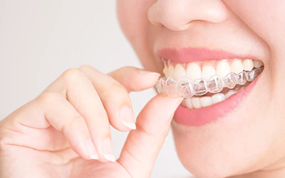 Invisible Braces – for a straighter grin invisibly