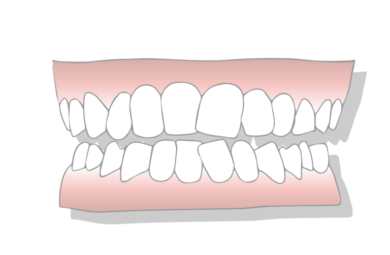 الأسنان الأولية (أللبنية) ألمنحرفة