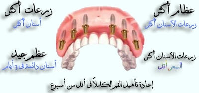 أفضل-عيادة-زراعة-أسنانعلاج-أسنان-في-الخبرالدمام،-السعودية-copy