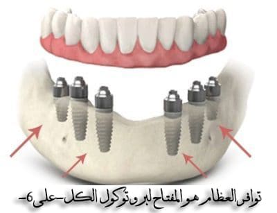 أفضل-عيادة-زراعة-أسنانعلاج-أسنان-في-الرياض،-السعودية-1