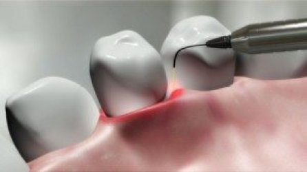 Benefits of Lanap Treatment for Gum Disease