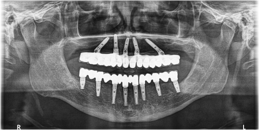 All-on-4-Dental-Implants-FMS-DENTAL.jpg