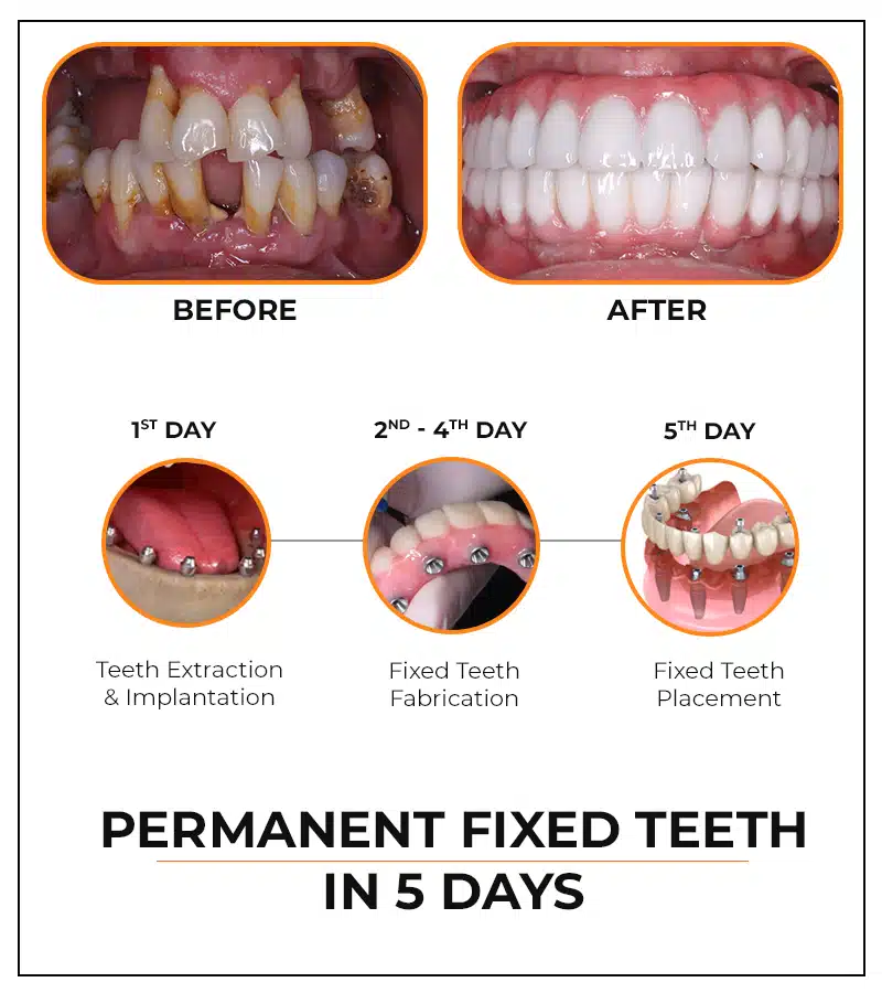 زرع أسنان في 5 أيام مع اسنان ثابتة دائمة