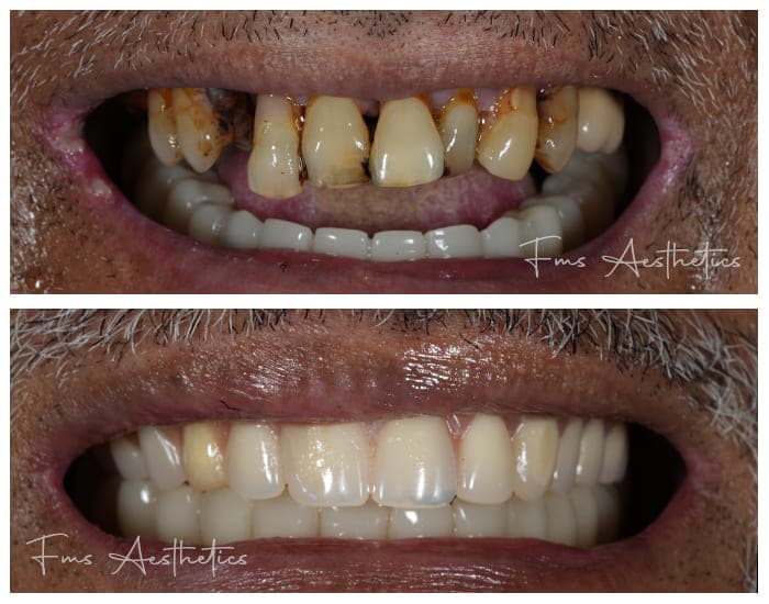 Dental-Implants-Treatment-1.jpg