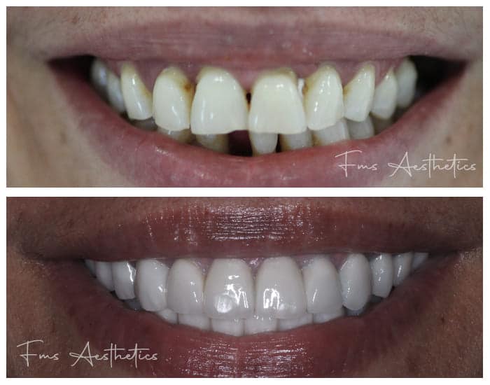 Dental-Implants-Treatment3.jpg