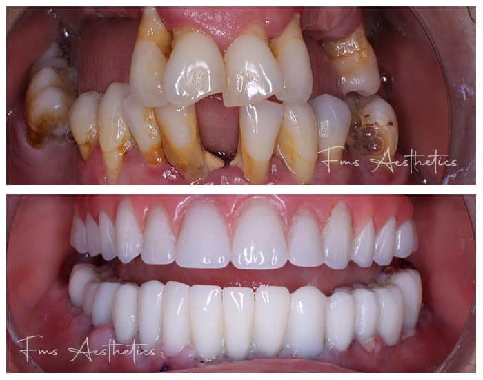 Dental-Implants-Treatment4.jpg