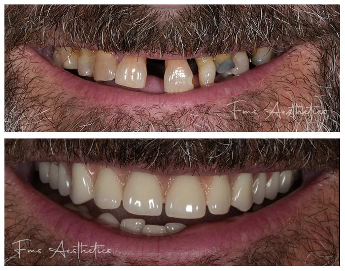 Dental-Implants-Treatment5.jpg