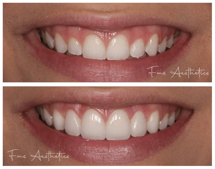 Gum-Reshaping-Treatment-2.jpg