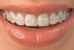 Ceramic-braces