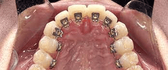 Lingual-braces