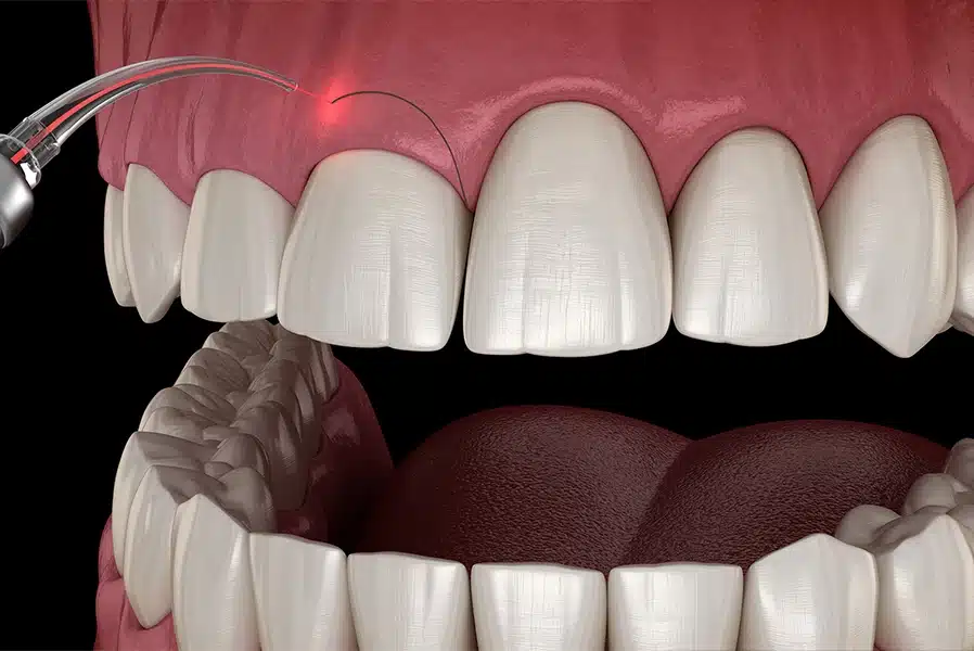 علاج استئصال اللثة في اف ام اس