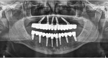 All-on-4-Dental-Implants-FMS-DENTAL.jpg
