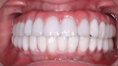 all-on-4-hybrid-prosthesis-FMS-DENTAL-Hyderabad-India-1024x713.jpg